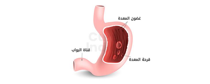 قرحة في المعدة أو قرحة هضمية